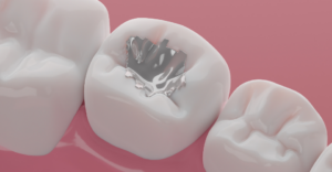 Broken Dental Fillings Treatment in Cleveland, OH