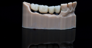 Dental Bridge - Emergency Dental of Cleveland