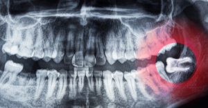 Wisdom Teeth Extraction at Emergency Dental of Cleveland
